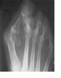 bunions x-ray