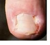 ingrown toenails